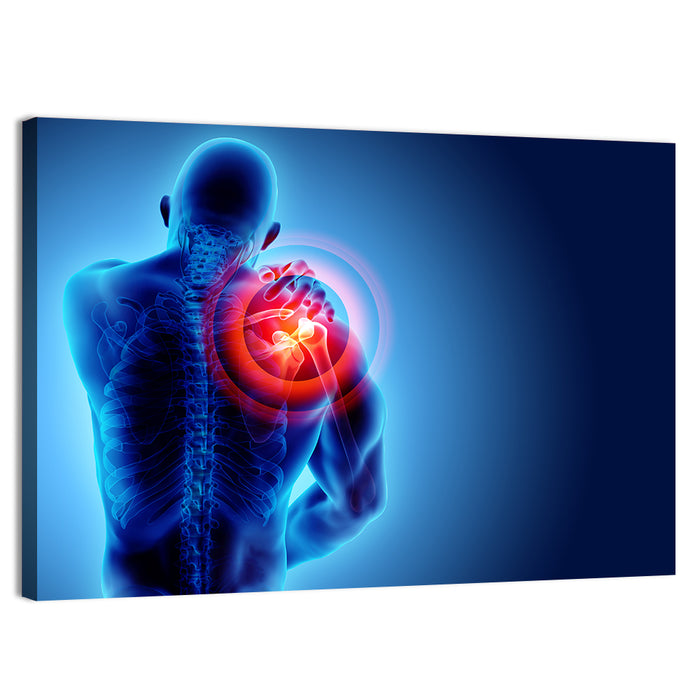 Shoulder Pain X-ray Wall Art as a canvas print