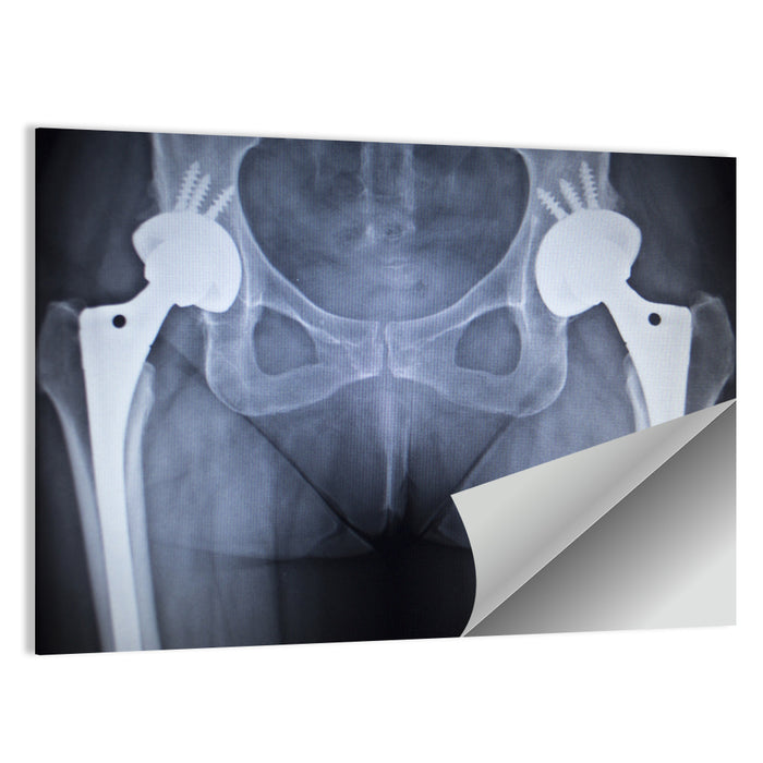 Pelvic X-ray with Hip Implants Wall Art as a poster print