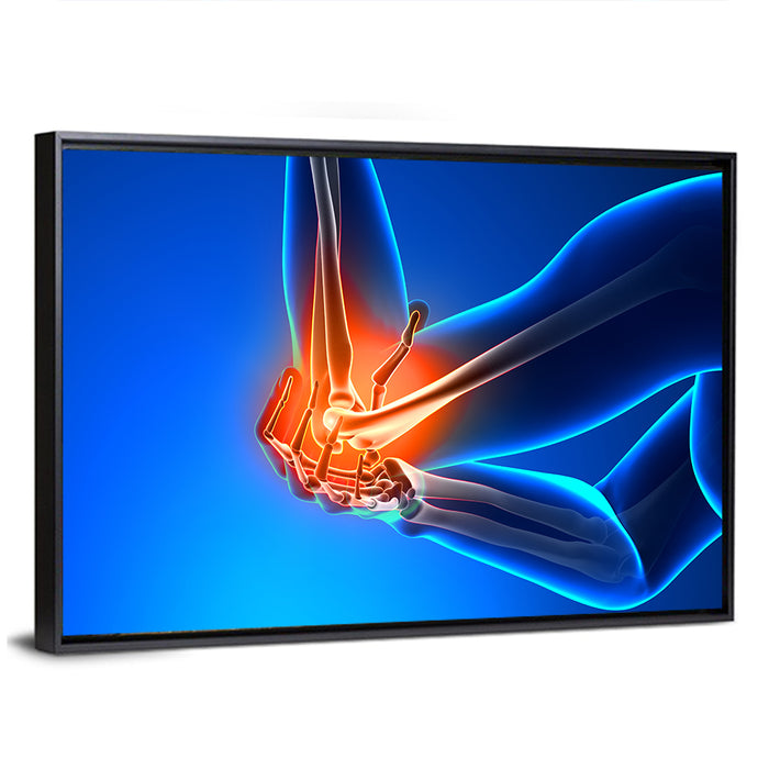Elbow Joint Inflammation Illustration Wall Art as a framed canvas