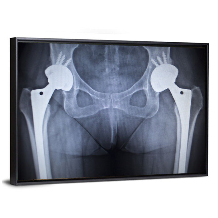 Pelvic X-ray with Hip Implants Wall Art as a framed canvas