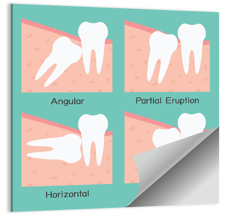 Wisdom Tooth Types Wall Art