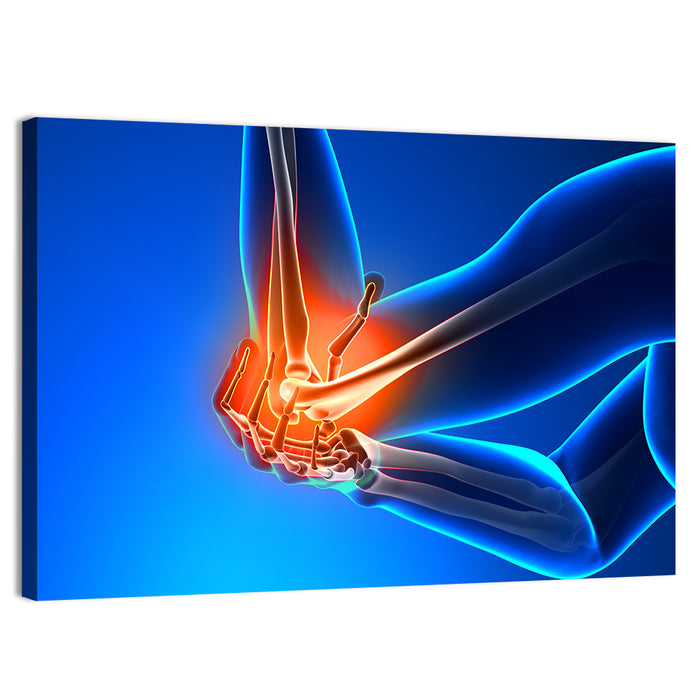 Elbow Joint Inflammation Illustration Wall Art as a canvas print