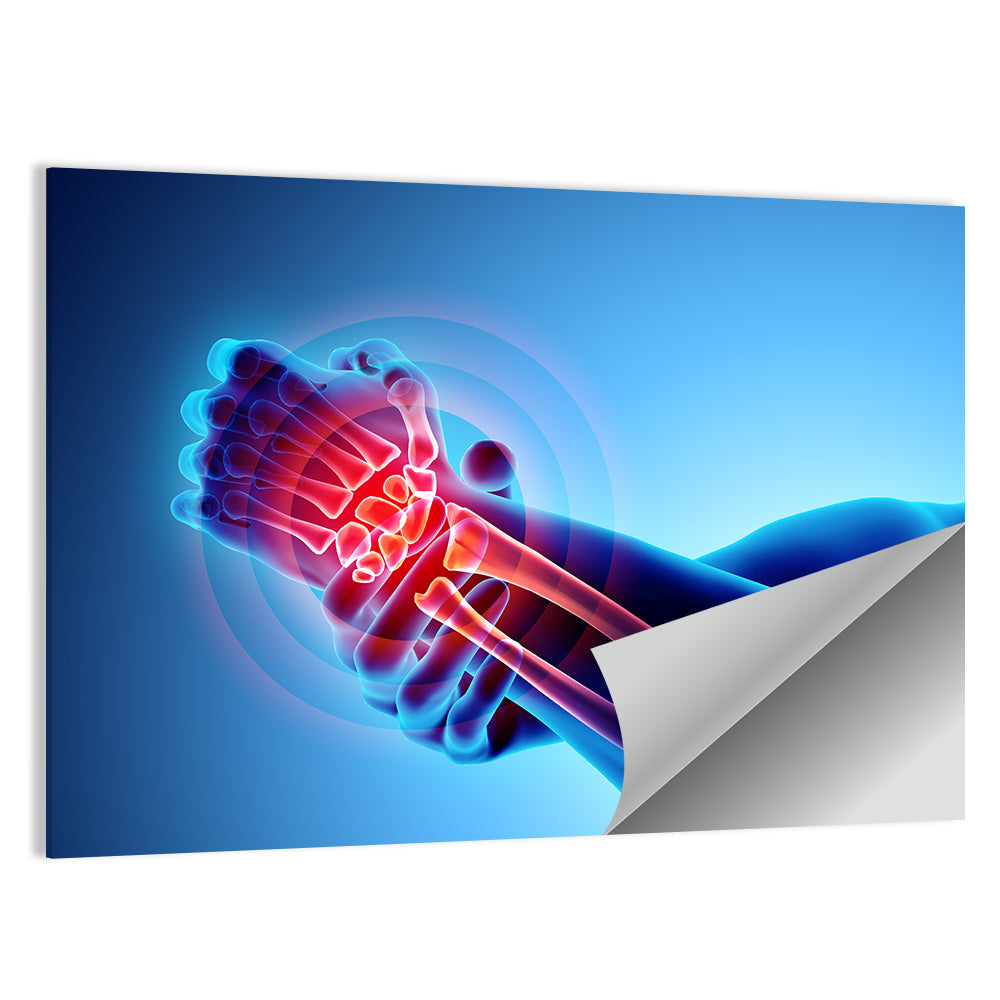 Painful Wrist X-ray Illustration Wall Art