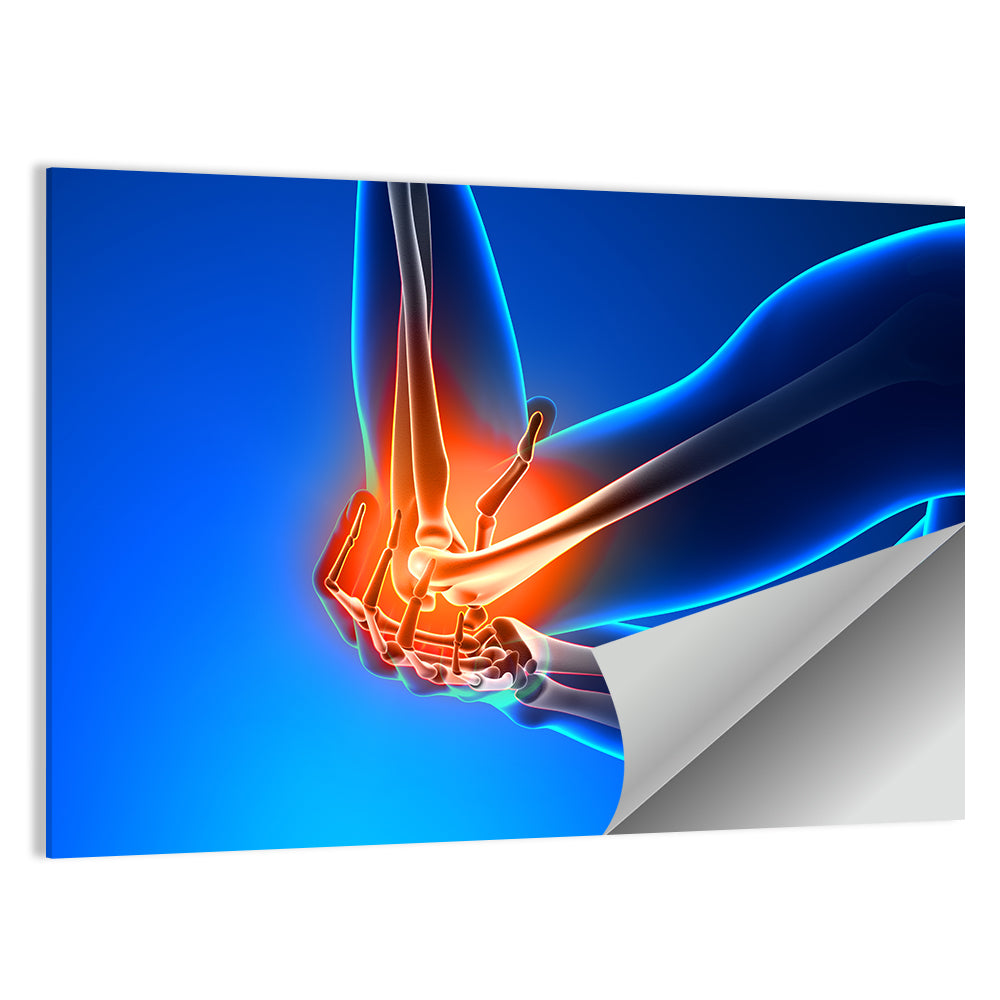 Elbow Joint Inflammation Illustration Wall Art