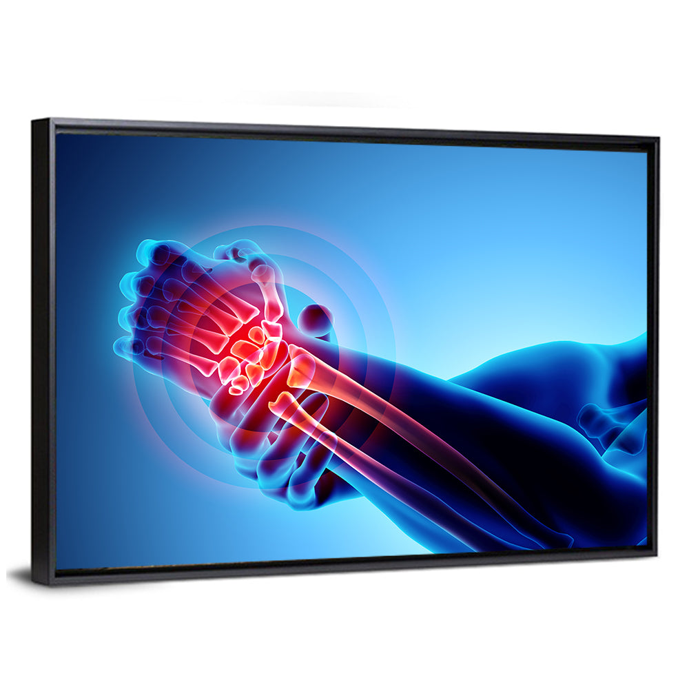 Painful Wrist X-ray Illustration Wall Art