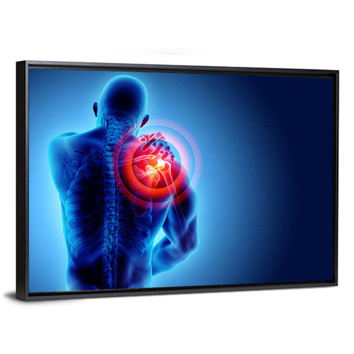 Shoulder Pain X-ray Wall Art as a framed canvas