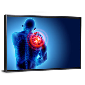 Shoulder Painful X-Ray Wall Art