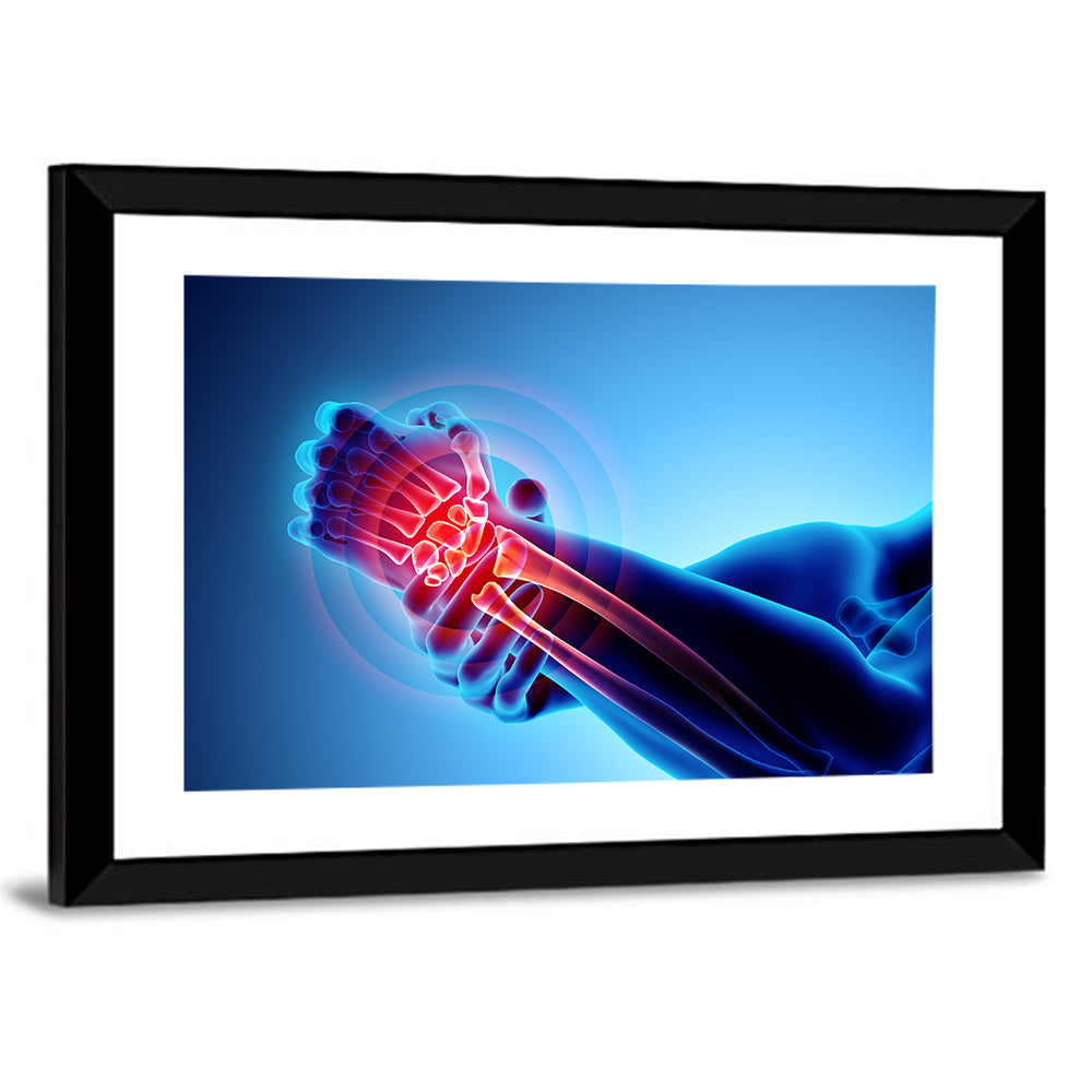 Painful Wrist X-ray Illustration Wall Art