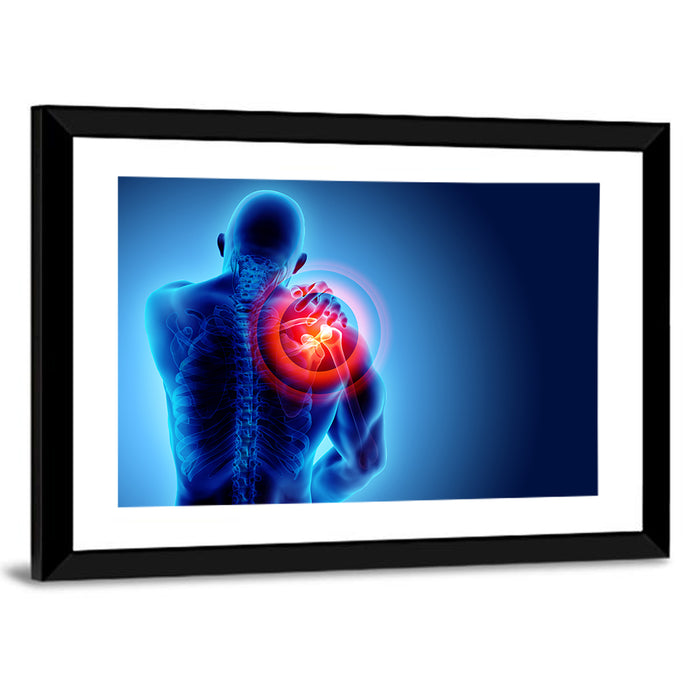 Shoulder Pain X-ray Wall Art as a framed print