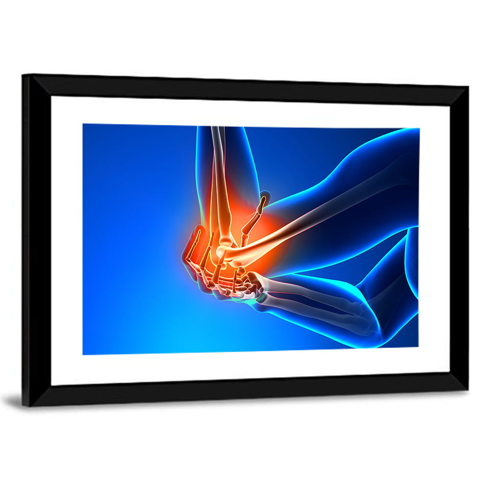 Elbow Joint Inflammation Illustration Wall Art
