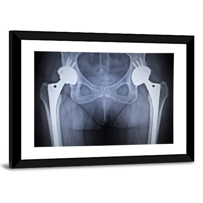 Pelvic X-ray with Hip Implants Wall Art as a framed print