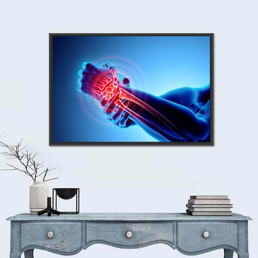 Painful Wrist X-ray Illustration Wall Art