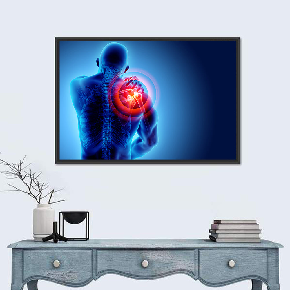 Shoulder Pain X-ray Wall Art