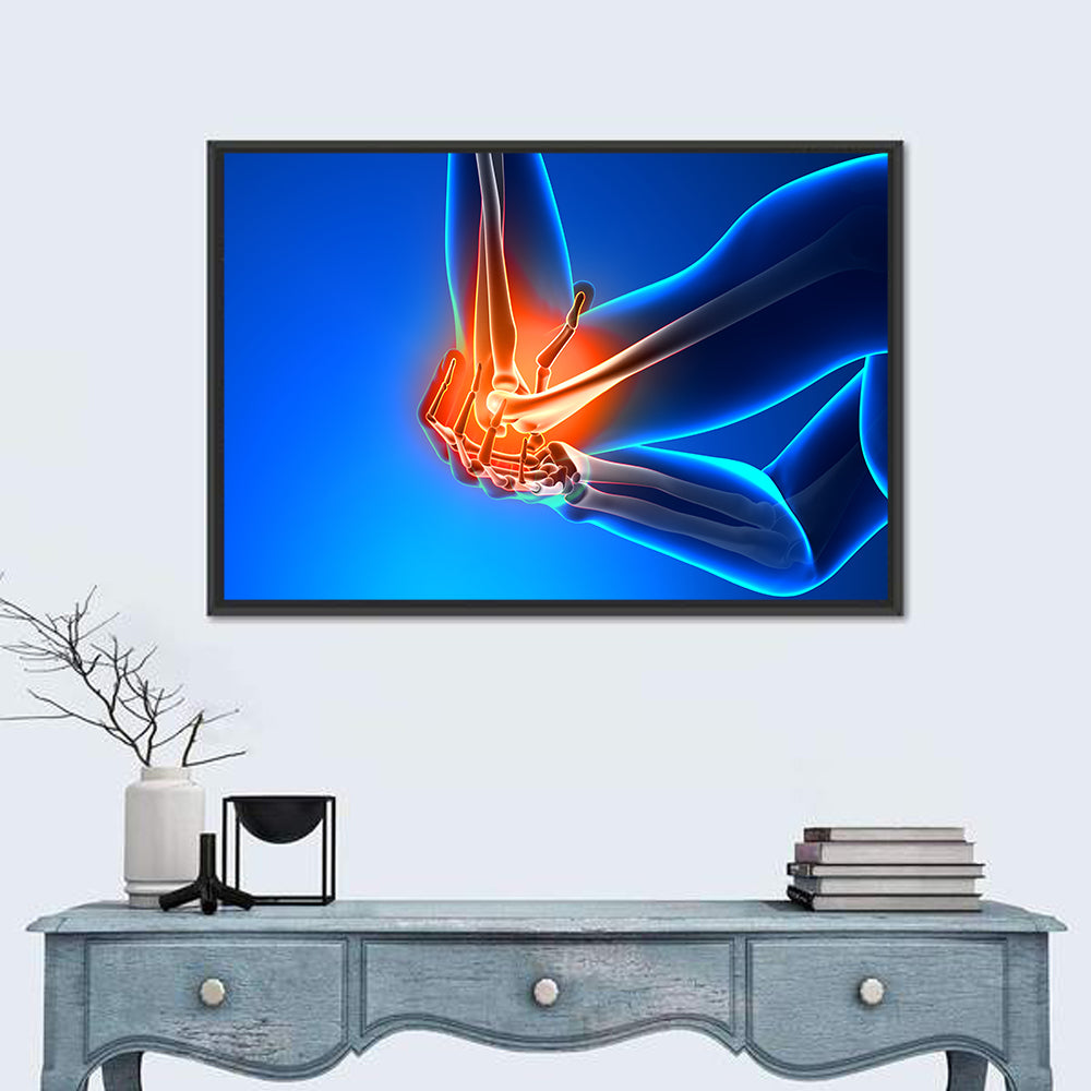 Elbow Joint Inflammation Illustration Wall Art