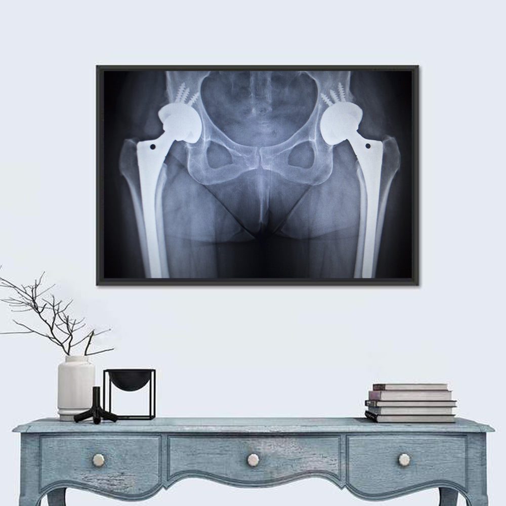 Pelvic X-ray with Hip Implants Wall Art in a room, landscape