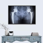 Pelvic X-ray with Hip Implants Wall Art