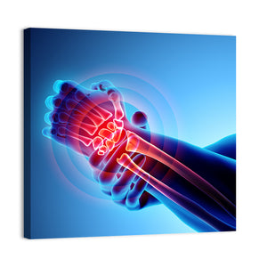 Wrist Painful X-Ray Wall Art