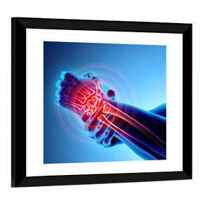 Wrist Painful X-Ray Wall Art