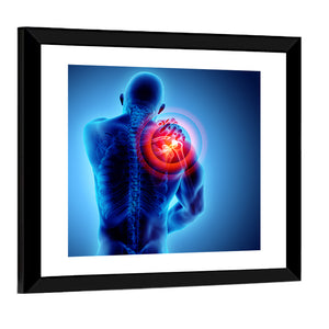 Shoulder Painful X-Ray Wall Art