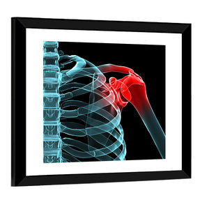 Painful Shoulder X Ray Wall Art