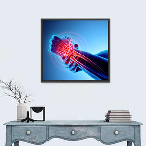 Wrist Painful X-Ray Wall Art