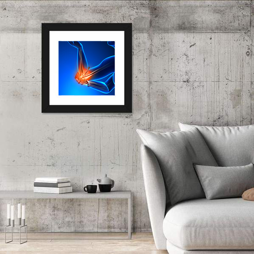 Elbow Joint Inflammation Illustration Wall Art