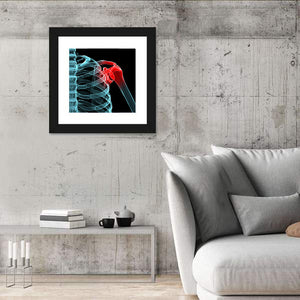 Painful Shoulder X Ray Wall Art