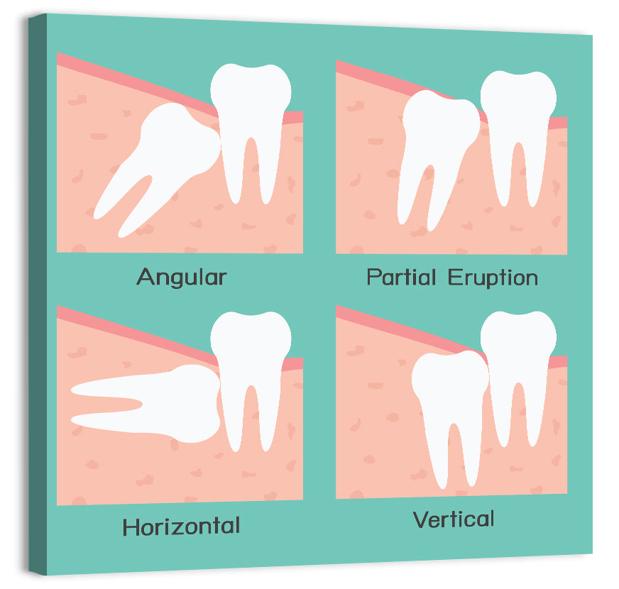Wisdom Tooth Types Wall Art