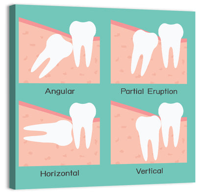 Wisdom Tooth Types Wall Art
