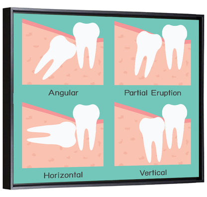 Wisdom Tooth Types Wall Art