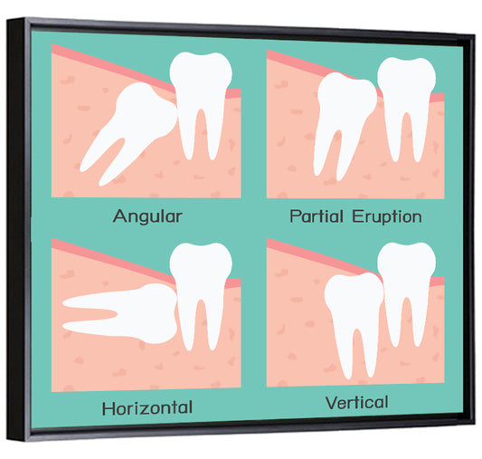 Wisdom Tooth Types Wall Art