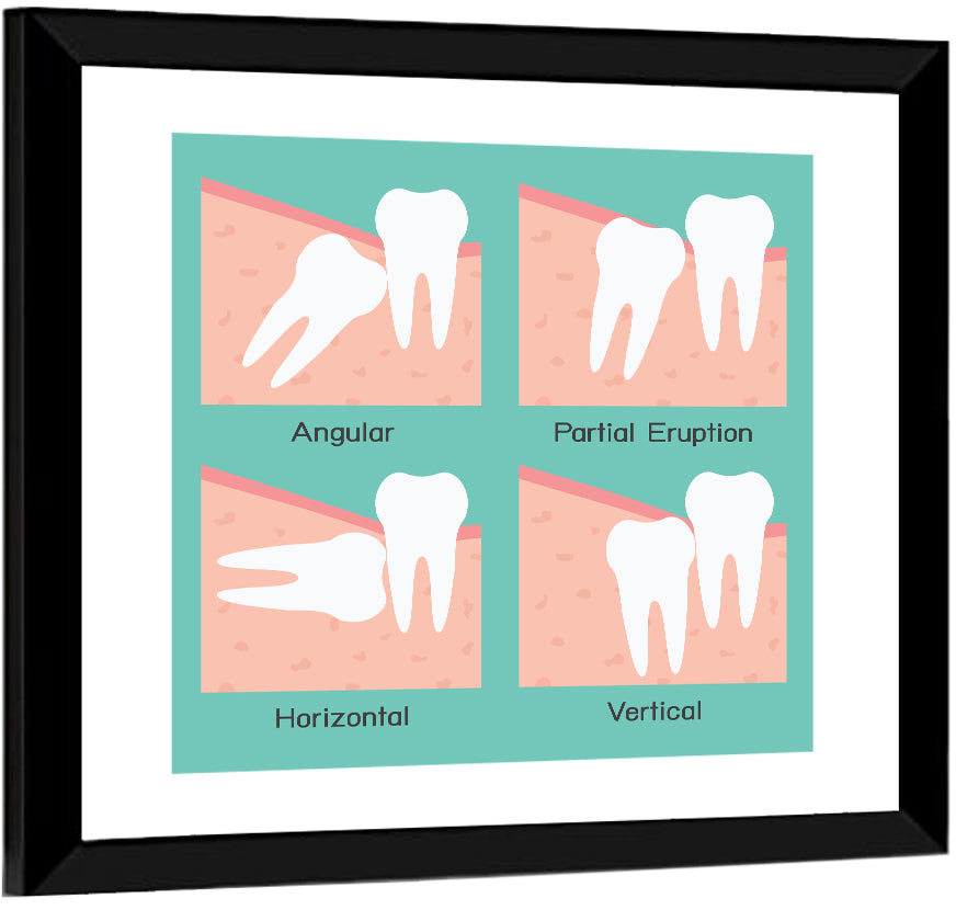 Wisdom Tooth Types Wall Art