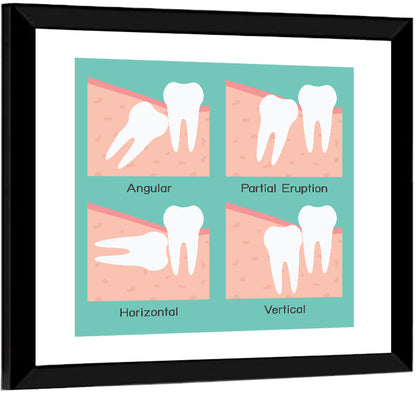 Wisdom Tooth Types Wall Art