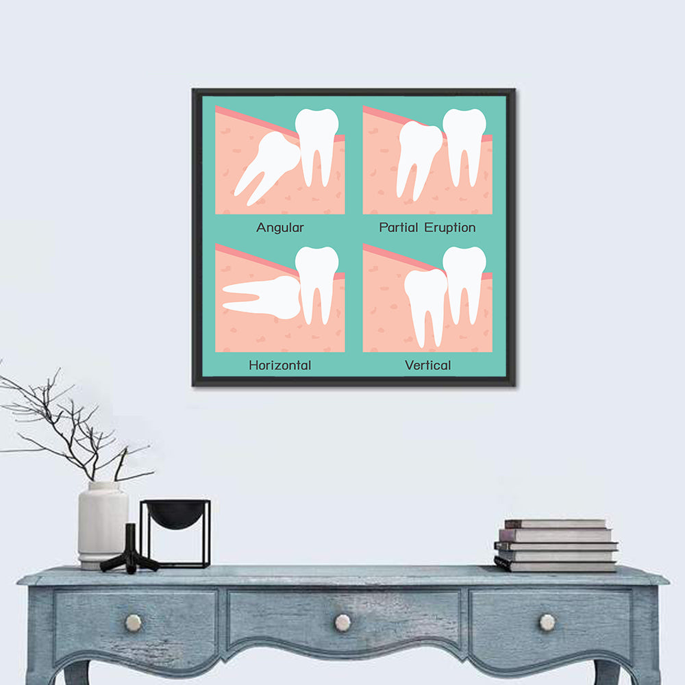 Wisdom Tooth Types Wall Art