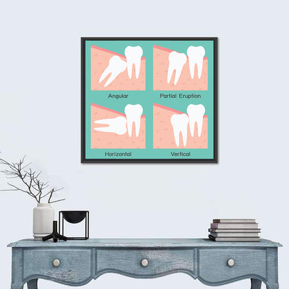 Wisdom Tooth Types Wall Art