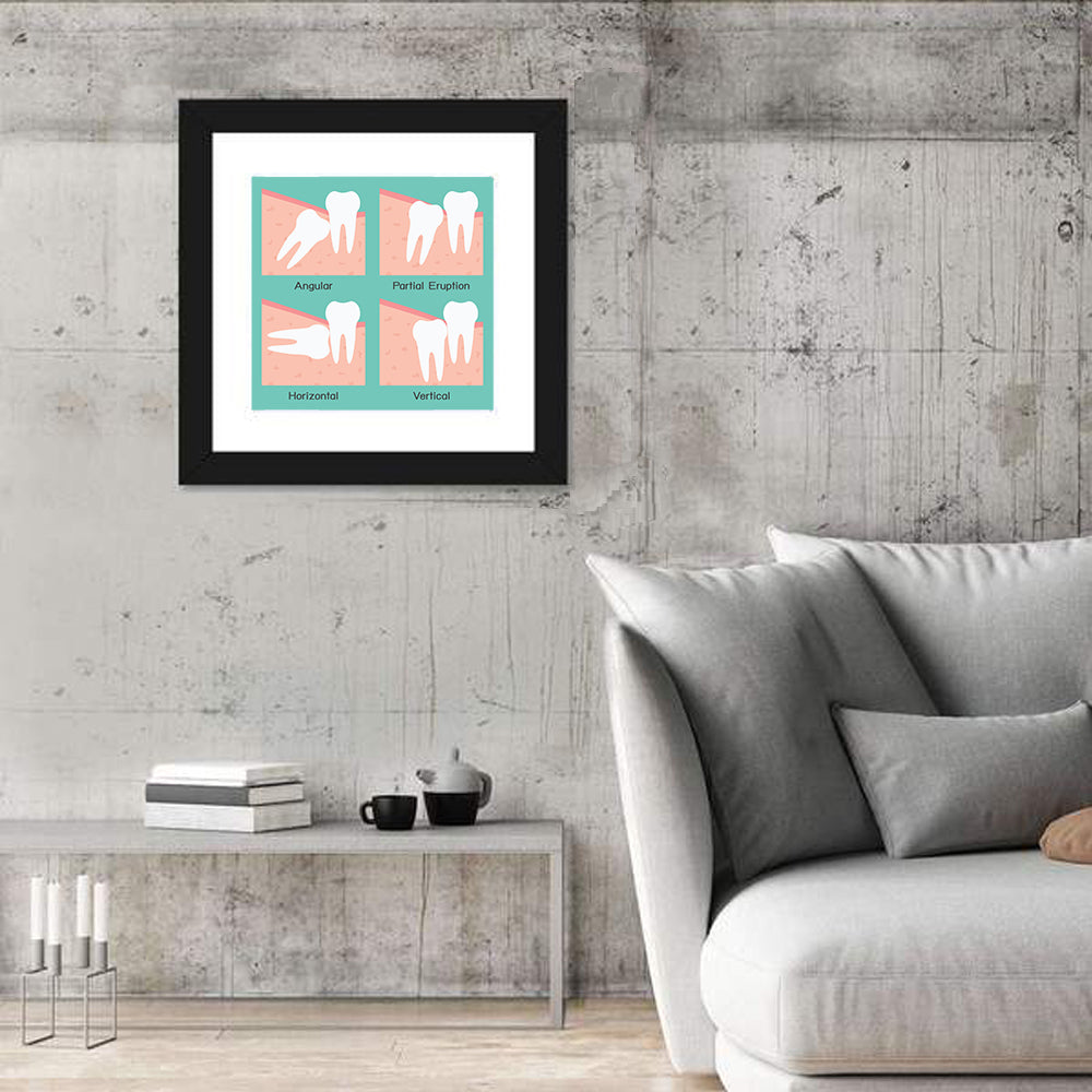 Wisdom Tooth Types Wall Art